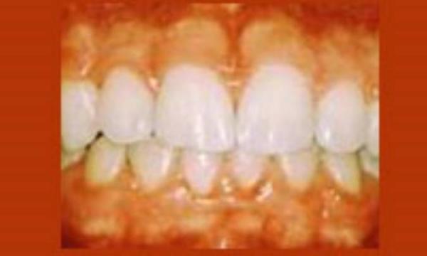 عاداتی که سبب تجمع پلاک های دندانی می گردد